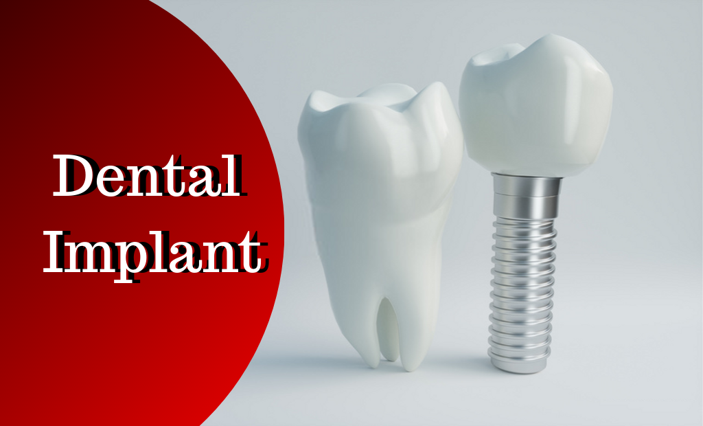 Best Dental Implant Clinic in Ahmedabad