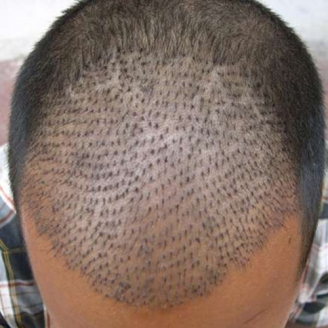 Pre and Post Precautions For FUE Hair Transplant Treatment
