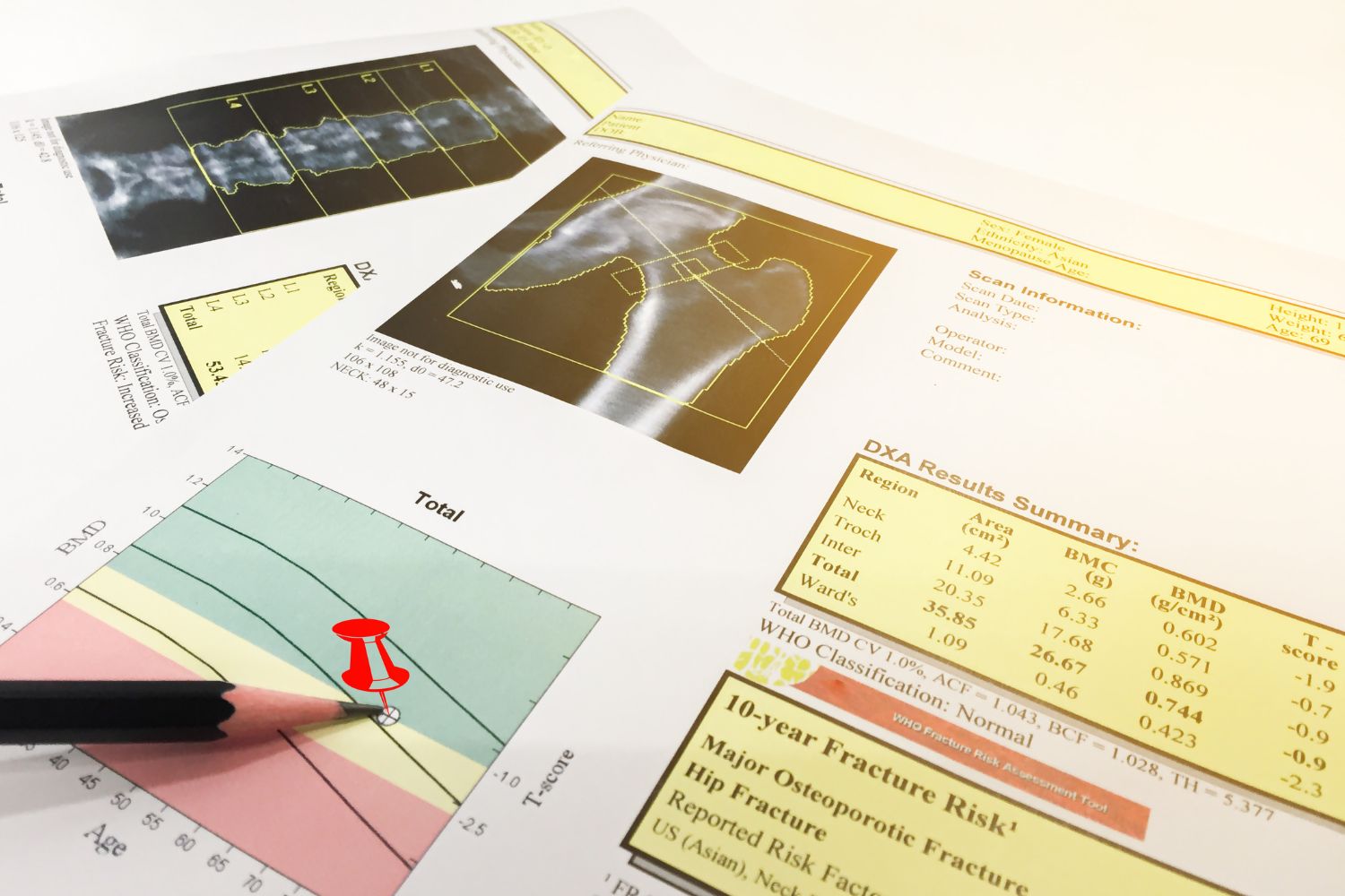 Looking for the best bone density scan