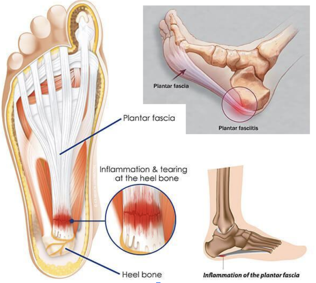 Plantar Fasciitis Relief: Effective Management Tips from ADAPT Recharge Plantar Fasciitis Relief: Effective Management Tips from ADAPT Recharge